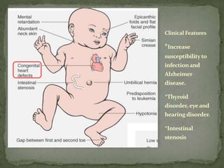 Clinical Features
*Increase
susceptibilityto
infectionand
Alzheimer
disease.
*Thyroid
disorder,eyeand
hearing disorder.
*Intestinal
stenosis
 