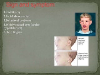 1. Cat like cry
2.Facial abnormality
3.Behavioral problems
4.Widely spaced eyes (ocular
hypertelorism)
5.Short fingers
 
