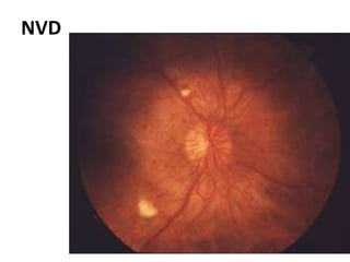 Nvd Optometry Structural and oct changes in diabetic retinopathy1 | PPTX