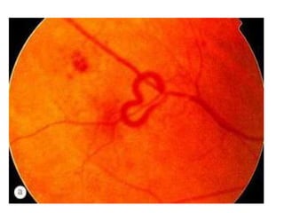 Structural and oct changes in diabetic retinopathy1 | PPTX