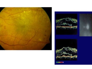 Structural and oct changes in diabetic retinopathy1 | PPTX