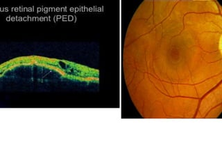 Structural and oct changes in diabetic retinopathy1 | PPTX