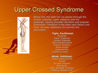Upper Crossed Syndrome Notice how the tight line (a) passes through the levator scapulae, upper trapezius and the pectorals, causing shoulder elevation and scapular protraction. Inhibition in the deep neck flexors and lower shoulder stabilizers (b) permits this asymmetry. Tight, Facilitated:     Pectorals Upper Trapezius Levator Scapulae Sternocleidomastoid Anterior Scalenes Suboccipitals Subscapularis Latissimus Dorsi  Weak, Inhibited: Longus Capitis & Colli Hyoids Serratus Anterior Rhomboids Lower & Middle Trapezius Posterior Rotator Cuff 