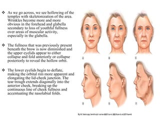  As we go across, we see hollowing of the
temples with skeletonization of the area.
Wrinkles become more and more
obvious in the forehead and glabella
secondary to loss of youthful fullness
over areas of muscular activity,
especially in the glabella.
 The fullness that was previously present
beneath the brow is now diminished and
the upper eyelids appear to either
collapse and fold anteriorly or collapse
posteriorly to reveal the hollow orbit.
 The lower eyelids begin to deflate,
making the orbital rim more apparent and
elongating the lid-cheek junction. The
tear trough extends diagonally into the
anterior cheek, breaking up the
continuous line of cheek fullness and
accentuating the nasolabial folds.
 
