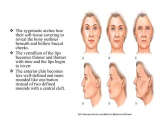 The zygomatic arches lose
their soft tissue covering to
reveal the bony outlines
beneath and hollow buccal
cheeks.
 The vermillion of the lips
becomes thinner and thinner
with time and the lips begin
to invert
 The anterior chin becomes
less well-defined and more
rounded like one button
instead of two defined
mounds with a central cleft.
 