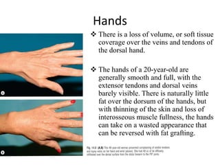 Hands
 There is a loss of volume, or soft tissue
coverage over the veins and tendons of
the dorsal hand.
 The hands of a 20-year-old are
generally smooth and full, with the
extensor tendons and dorsal veins
barely visible. There is naturally little
fat over the dorsum of the hands, but
with thinning of the skin and loss of
interosseous muscle fullness, the hands
can take on a wasted appearance that
can be reversed with fat grafting.
 