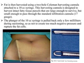  Fat is then harvested using a two-hole Coleman harvesting cannula
attached to a 10 cc syringe. This harvesting cannula is designed to
harvest intact fatty tissue parcels that are large enough to survive, but
small enough to pass through the standard infiltration cannula (17
gauge).
 The plunger of the 10 cc syringe is pulled back only a few milliliters
during suctioning, so as not to create too much negative pressure and
rupture the fat cells.
 