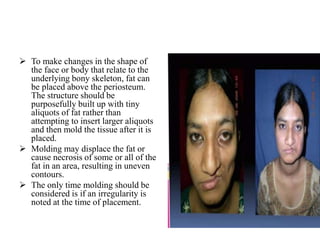  To make changes in the shape of
the face or body that relate to the
underlying bony skeleton, fat can
be placed above the periosteum.
The structure should be
purposefully built up with tiny
aliquots of fat rather than
attempting to insert larger aliquots
and then mold the tissue after it is
placed.
 Molding may displace the fat or
cause necrosis of some or all of the
fat in an area, resulting in uneven
contours.
 The only time molding should be
considered is if an irregularity is
noted at the time of placement.
 