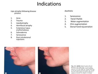 Indications
Lipo-atrophy following disease
process
1. Acne
2. Trauma
3. Lipodystrophy
4. Hemifacial atrophy
5. Cutaneous lupus
erythematosus
6. Scleroderma
7. Senescence
8. Post-intralesional
injections
Aesthetic
1. Senescence
2. Facial rhytids
3. Malar augmentation
4. Chin augmentation
5. Dorsal hand rejuvenation
 