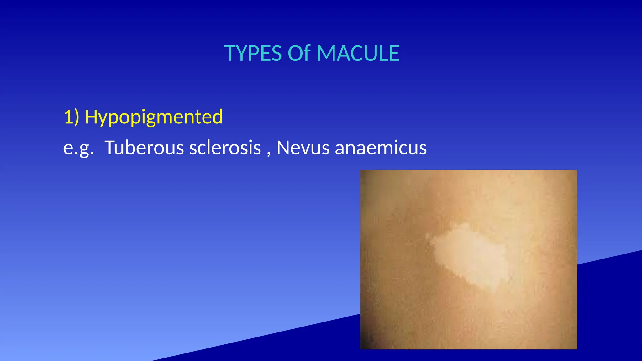 TYPES Of MACULE
1) Hypopigmented
e.g. Tuberous sclerosis , Nevus anaemicus
 