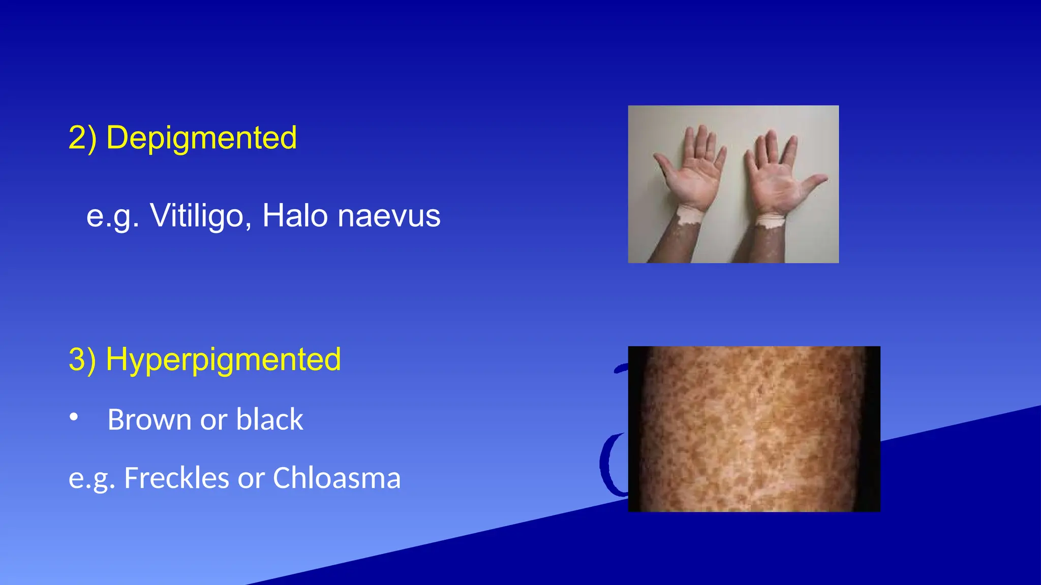 2) Depigmented
e.g. Vitiligo, Halo naevus
3) Hyperpigmented
• Brown or black
e.g. Freckles or Chloasma
 