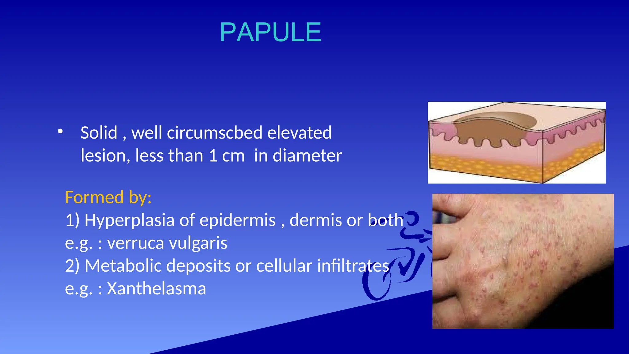 PAPULE
• Solid , well circumscbed elevated
lesion, less than 1 cm in diameter
Formed by:
1) Hyperplasia of epidermis , dermis or both
e.g. : verruca vulgaris
2) Metabolic deposits or cellular infiltrates
e.g. : Xanthelasma
 