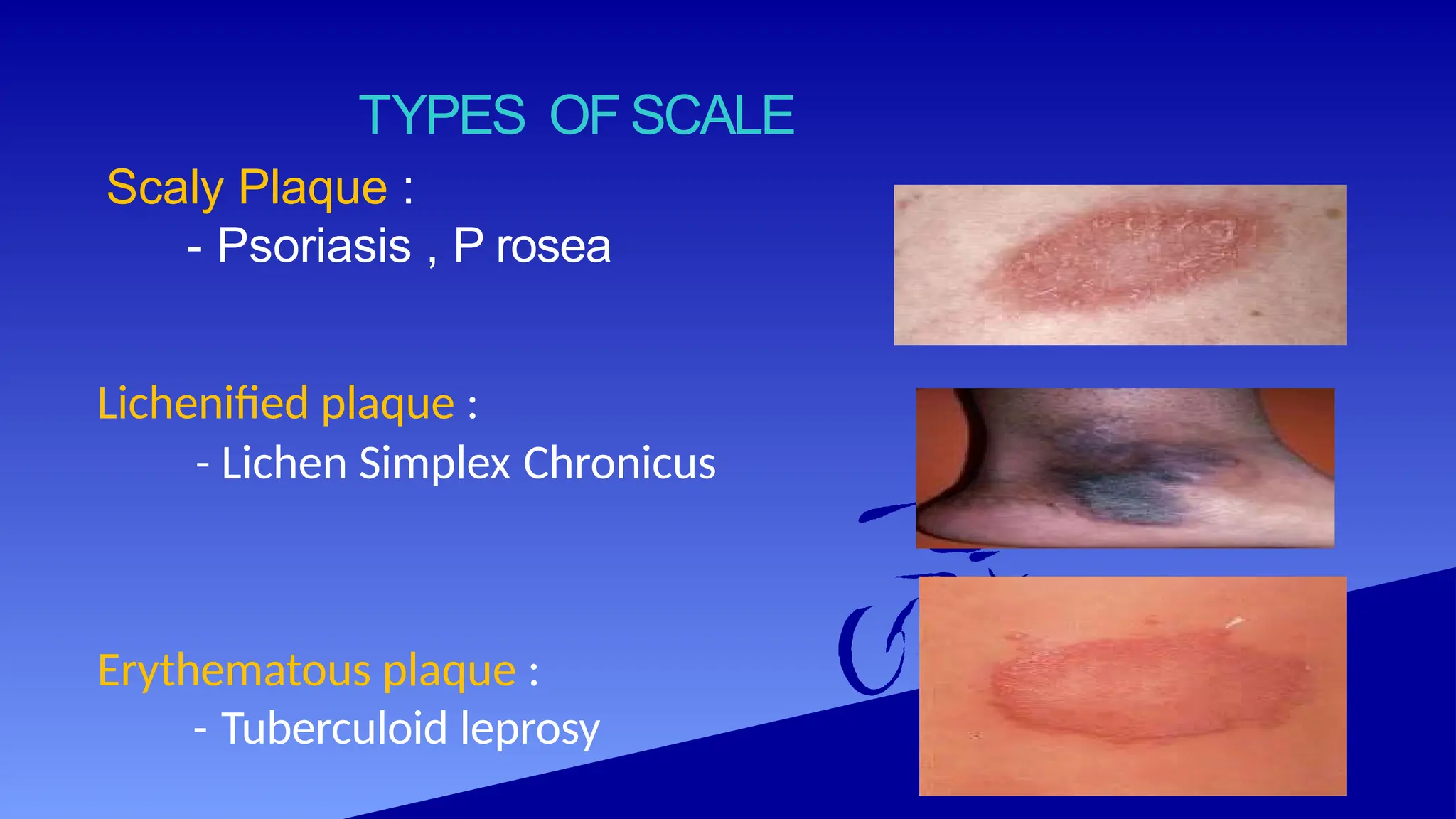 TYPES OF SCALE
Scaly Plaque :
- Psoriasis , P rosea
Lichenified plaque :
- Lichen Simplex Chronicus
Erythematous plaque :
- Tuberculoid leprosy
 