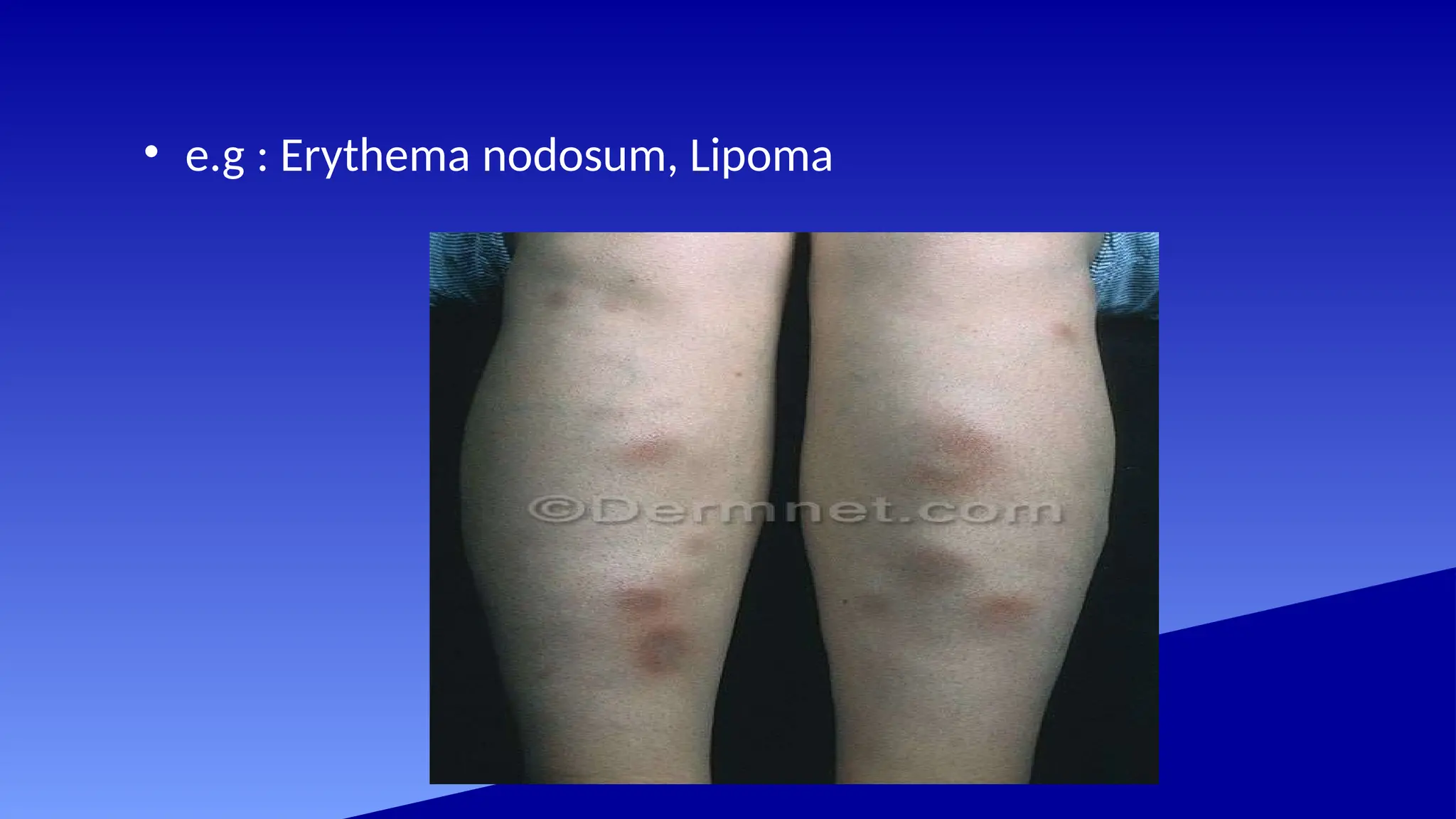 • e.g : Erythema nodosum, Lipoma
 