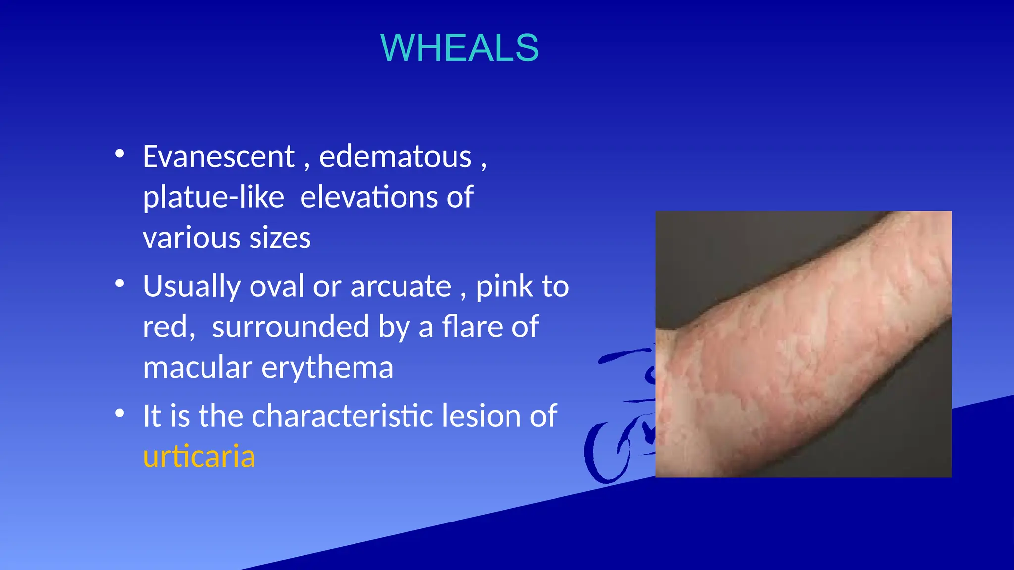 WHEALS
• Evanescent , edematous ,
platue-like elevations of
various sizes
• Usually oval or arcuate , pink to
red, surrounded by a flare of
macular erythema
• It is the characteristic lesion of
urticaria
 