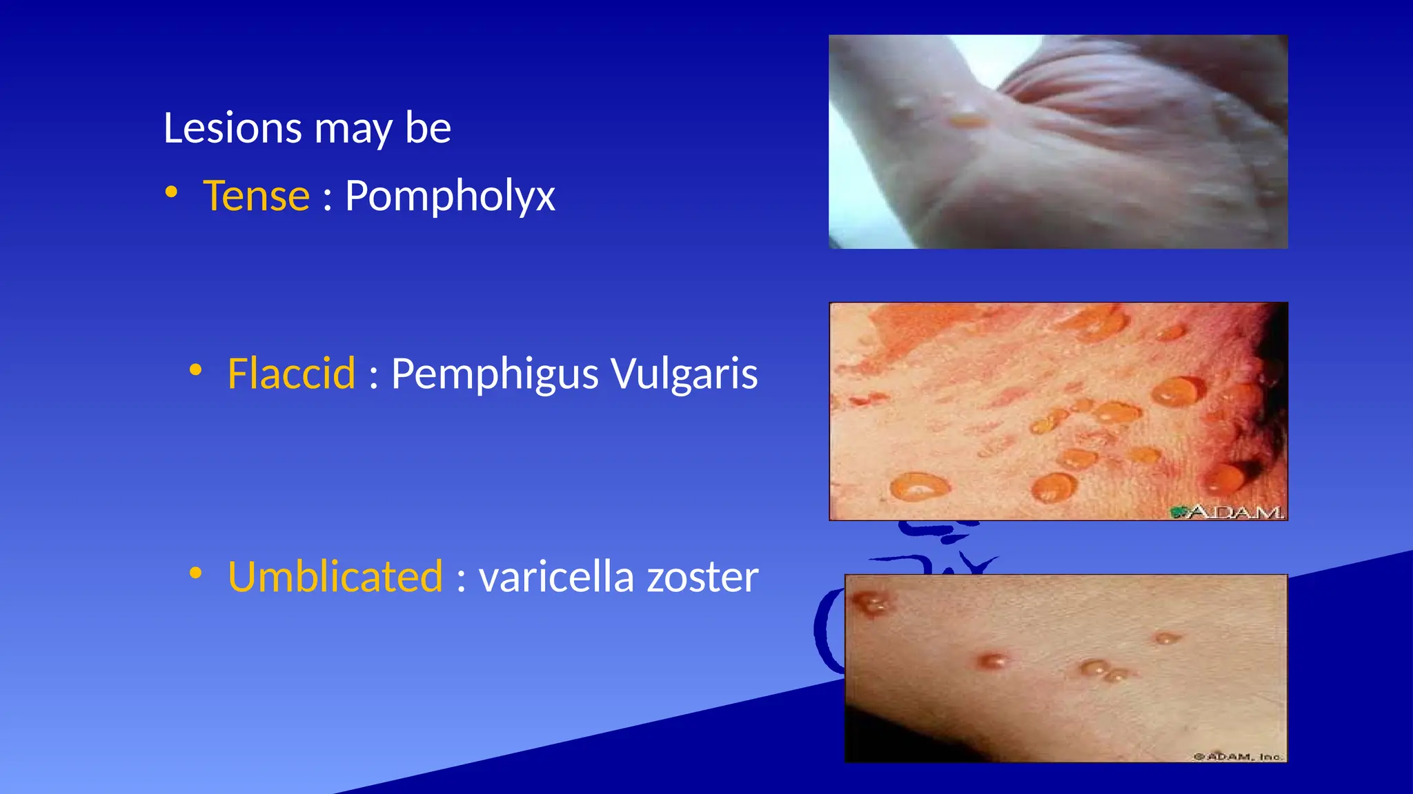 Lesions may be
• Tense : Pompholyx
• Flaccid : Pemphigus Vulgaris
• Umblicated : varicella zoster
 