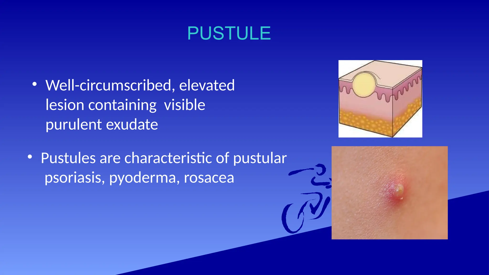 PUSTULE
• Well-circumscribed, elevated
lesion containing visible
purulent exudate
• Pustules are characteristic of pustular
psoriasis, pyoderma, rosacea
 