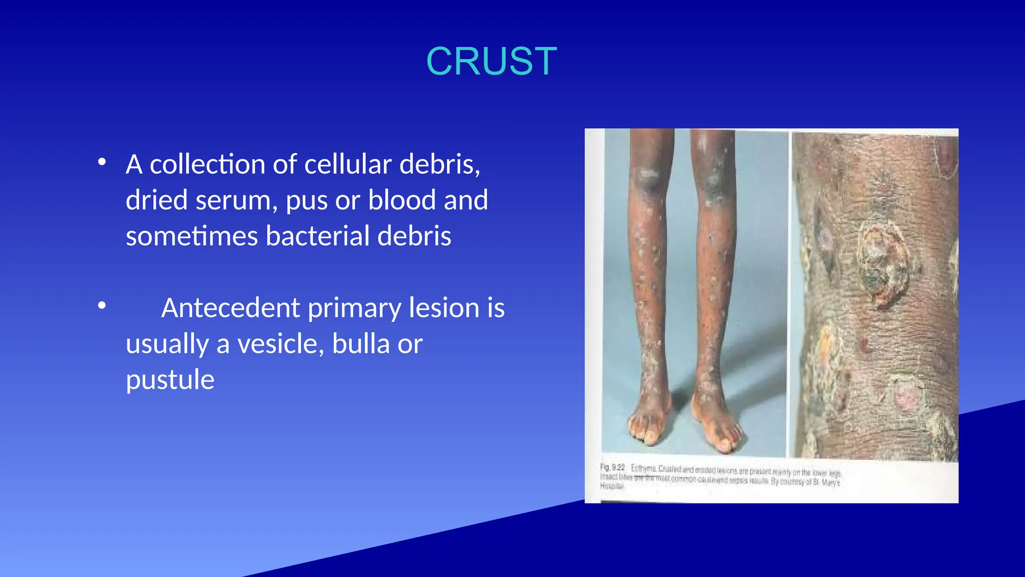 CRUST
• A collection of cellular debris,
dried serum, pus or blood and
sometimes bacterial debris
• Antecedent primary lesion is
usually a vesicle, bulla or
pustule
 