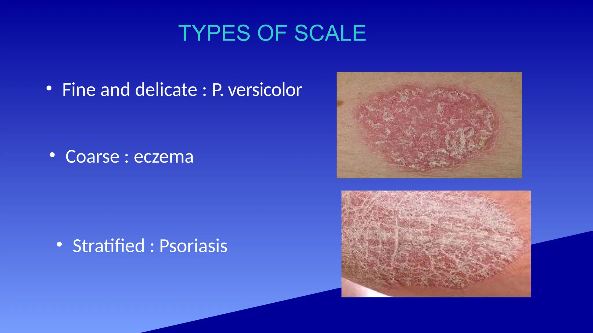 TYPES OF SCALE
• Fine and delicate : P. versicolor
• Coarse : eczema
• Stratified : Psoriasis
 