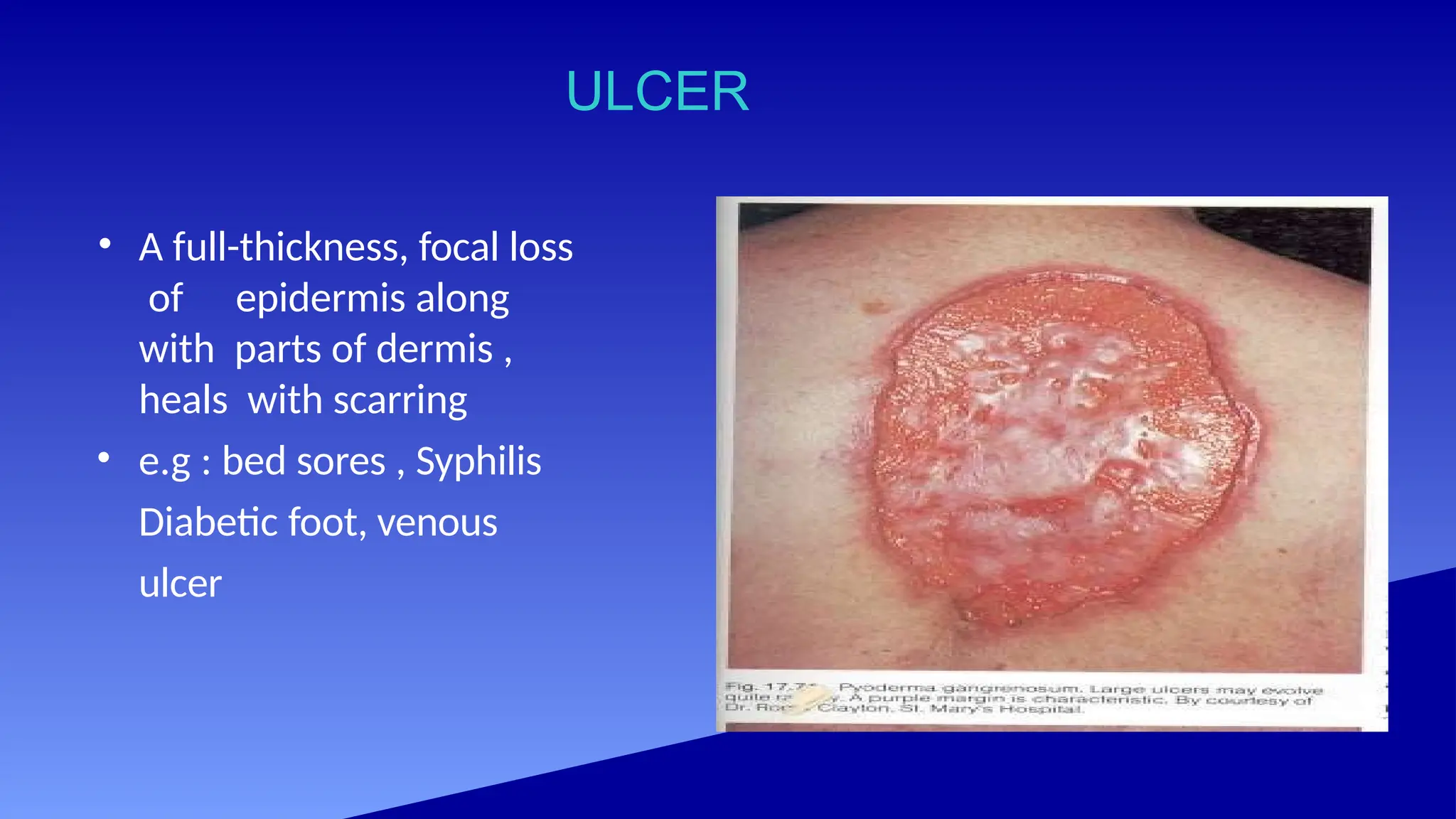 ULCER
• A full-thickness, focal loss
of epidermis along
with parts of dermis ,
heals with scarring
• e.g : bed sores , Syphilis
Diabetic foot, venous
ulcer
 