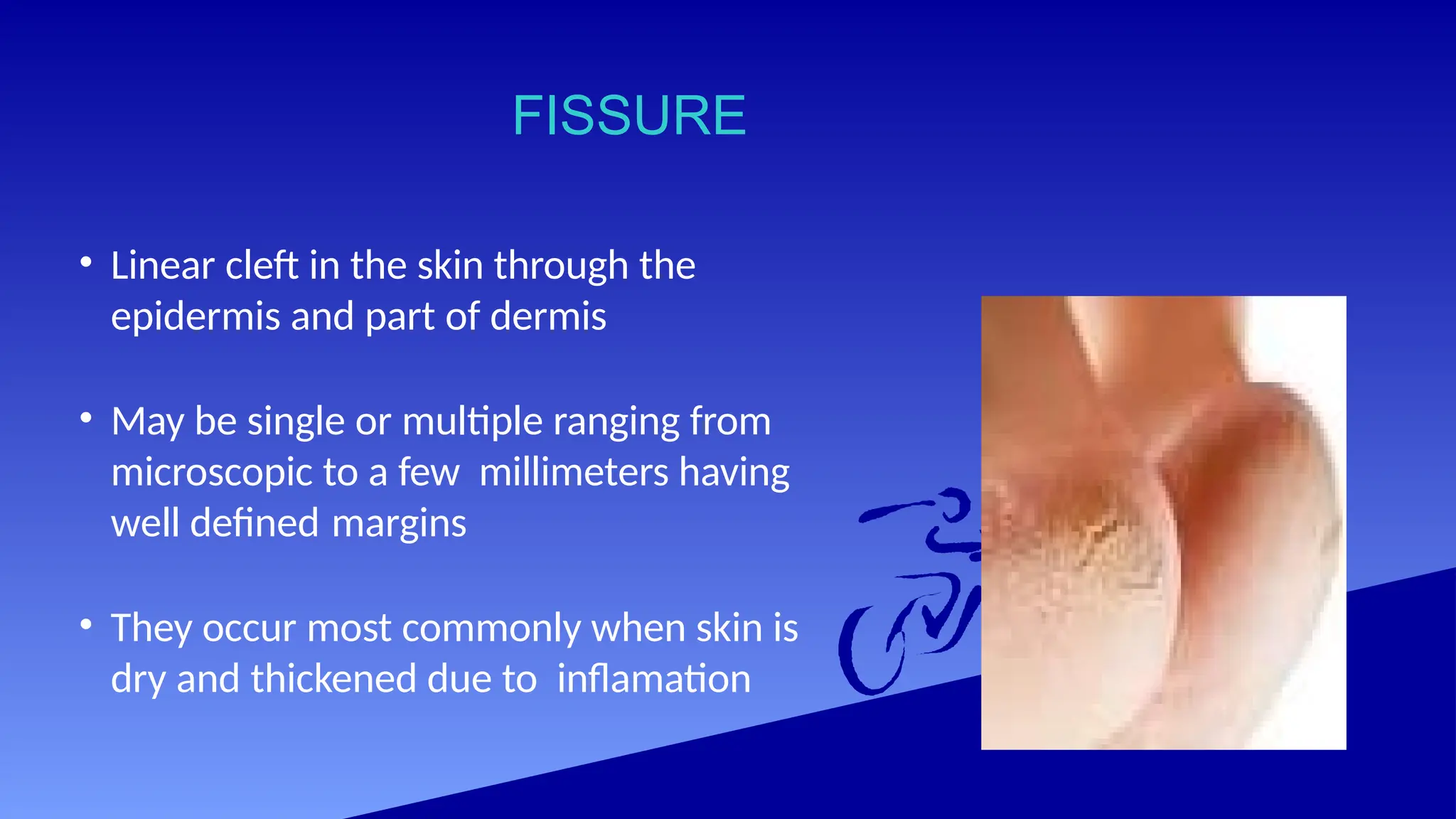FISSURE
• Linear cleft in the skin through the
epidermis and part of dermis
• May be single or multiple ranging from
microscopic to a few millimeters having
well defined margins
• They occur most commonly when skin is
dry and thickened due to inflamation
 