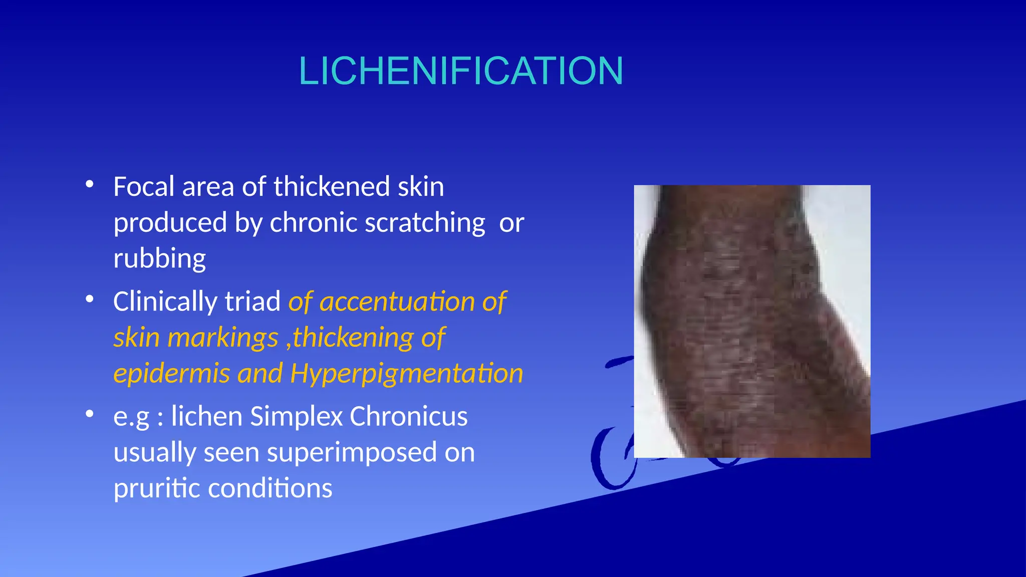 LICHENIFICATION
• Focal area of thickened skin
produced by chronic scratching or
rubbing
• Clinically triad of accentuation of
skin markings ,thickening of
epidermis and Hyperpigmentation
• e.g : lichen Simplex Chronicus
usually seen superimposed on
pruritic conditions
 