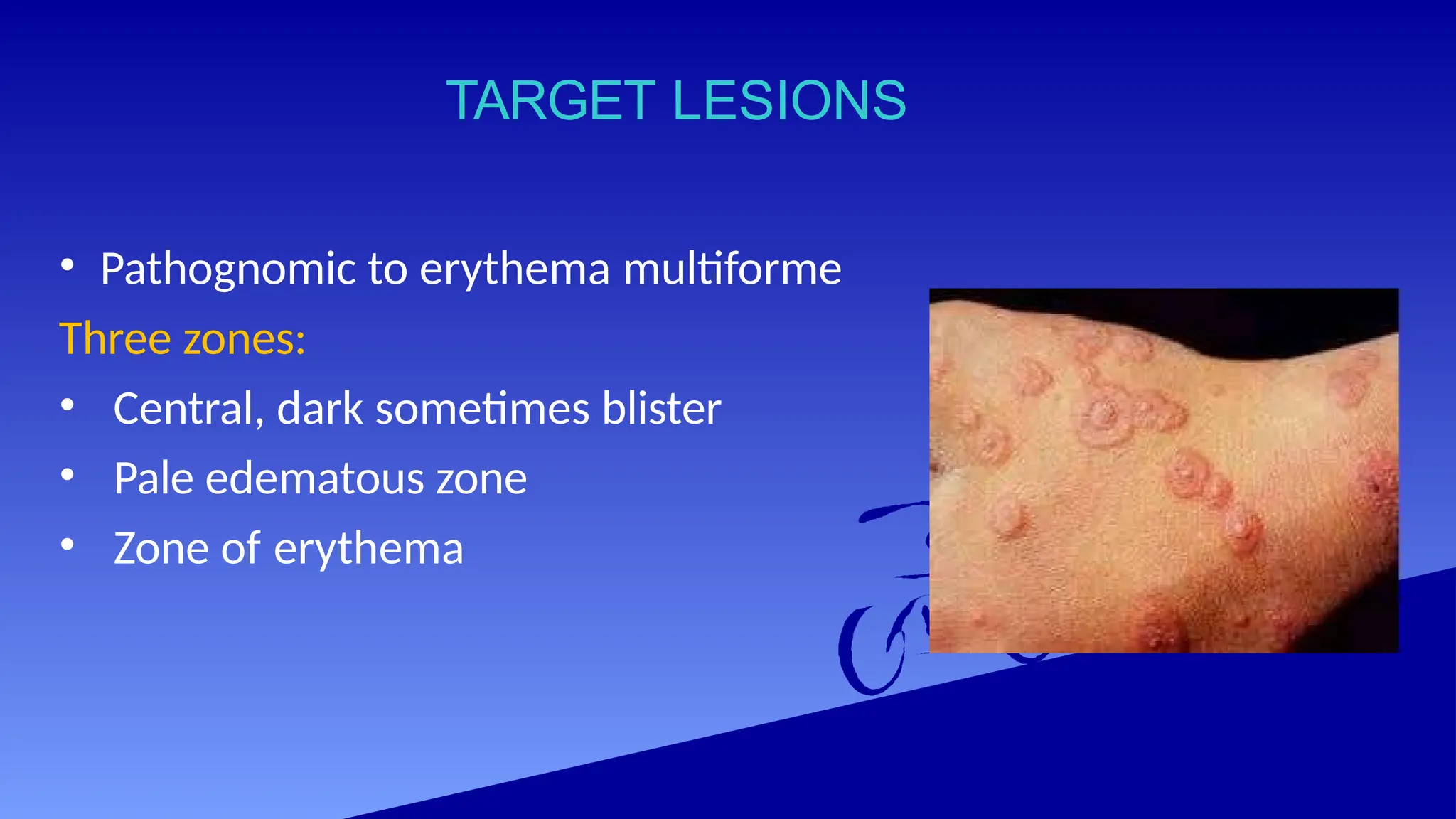 TARGET LESIONS
• Pathognomic to erythema multiforme
Three zones:
• Central, dark sometimes blister
• Pale edematous zone
• Zone of erythema
 
