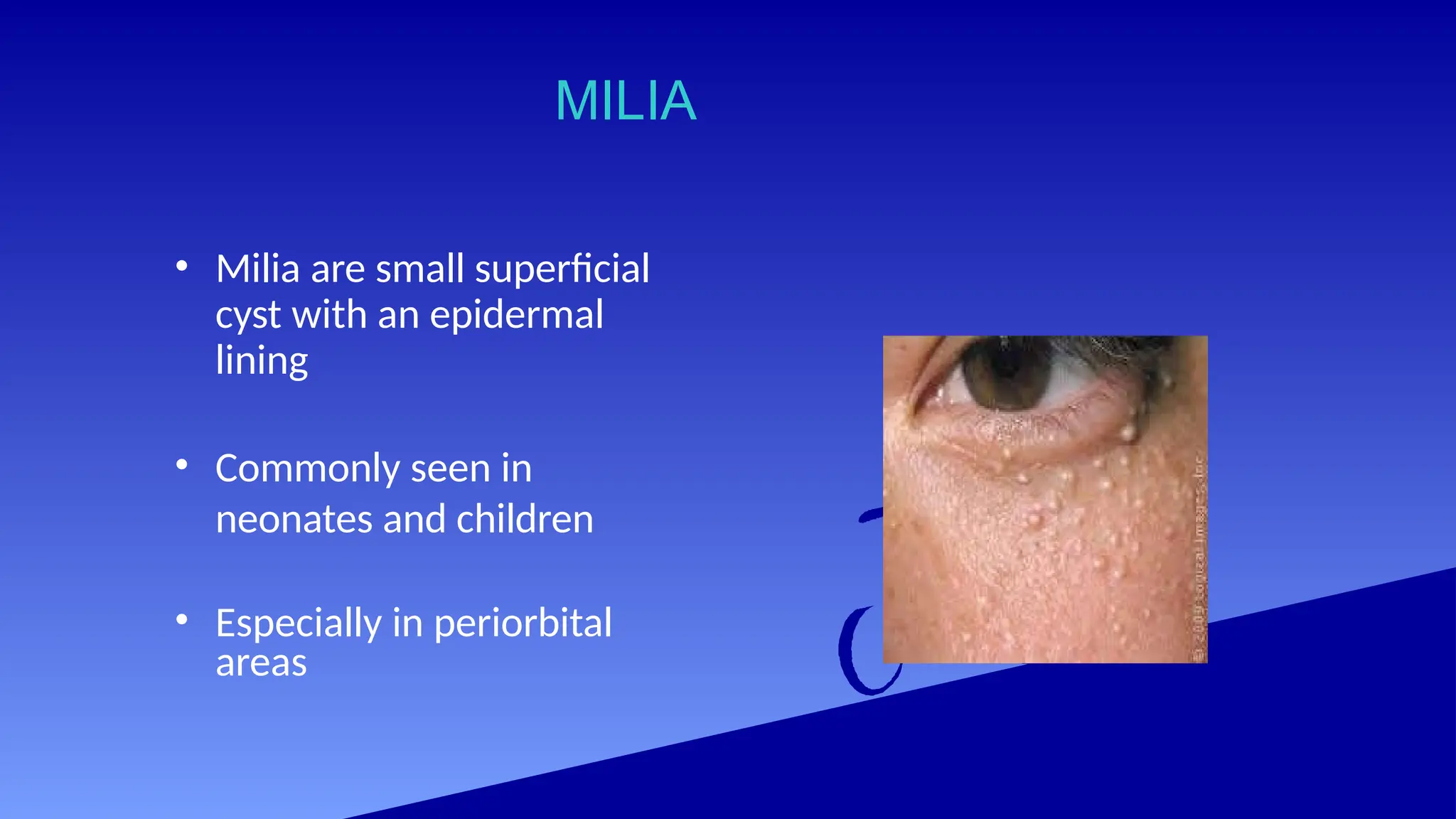 MILIA
• Milia are small superficial
cyst with an epidermal
lining
• Commonly seen in
neonates and children
• Especially in periorbital
areas
 