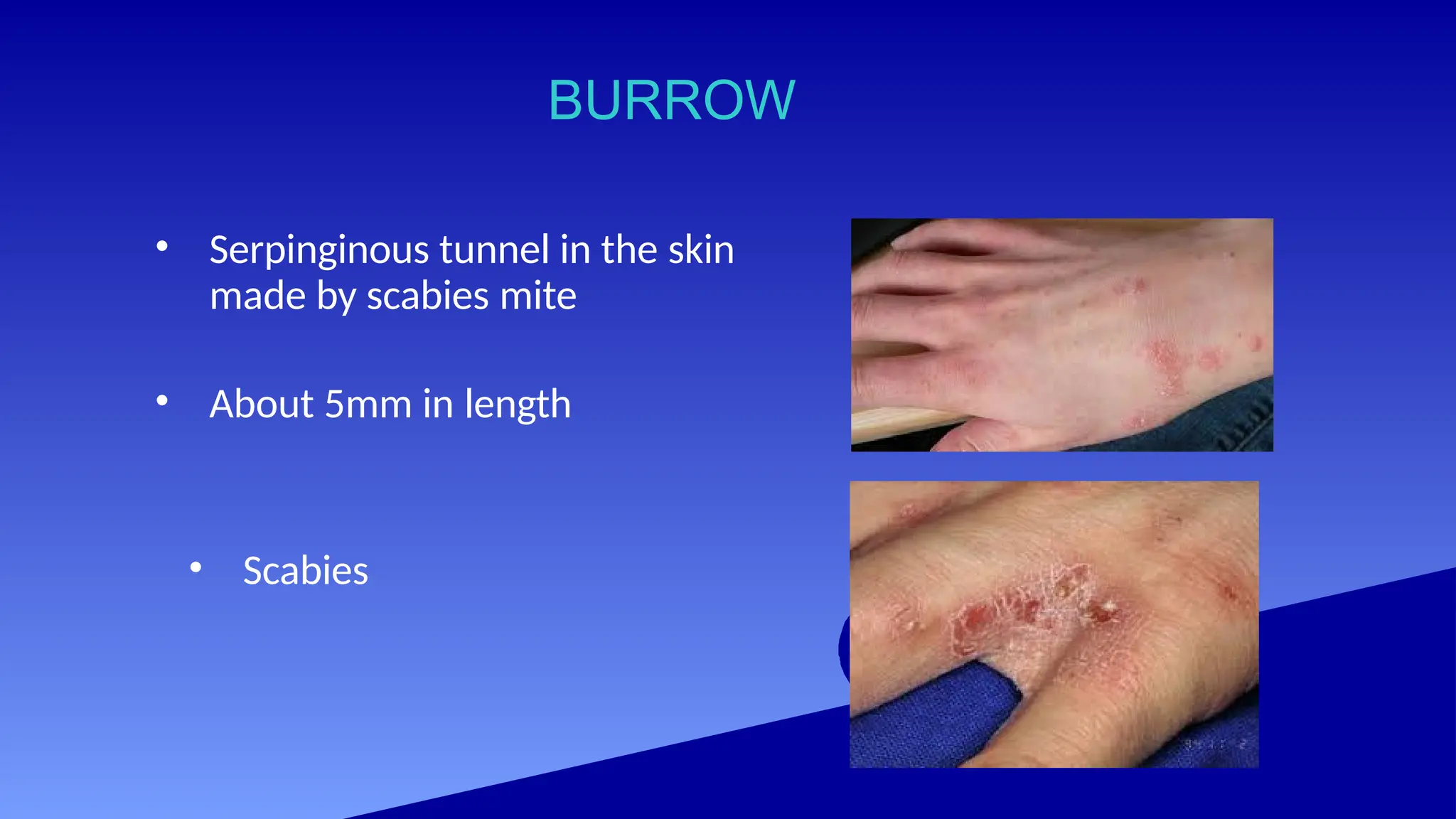 BURROW
• Serpinginous tunnel in the skin
made by scabies mite
• About 5mm in length
• Scabies
 