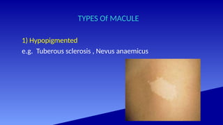 Macule Most Common Example structure and function of structure and function of skin- | PPTX