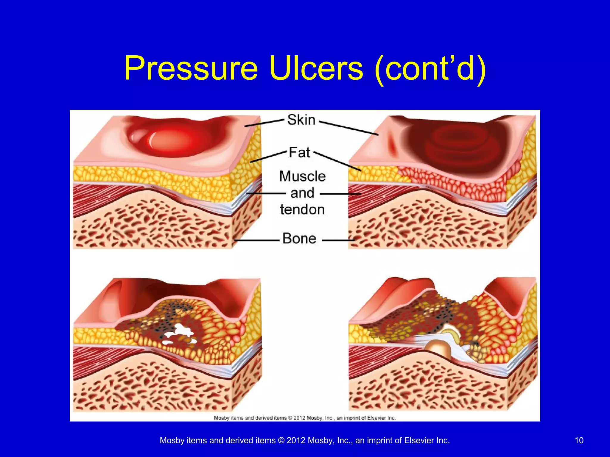 Mosby items and derived items © 2012 Mosby, Inc., an imprint of Elsevier Inc. 10
Pressure Ulcers (cont’d)
 