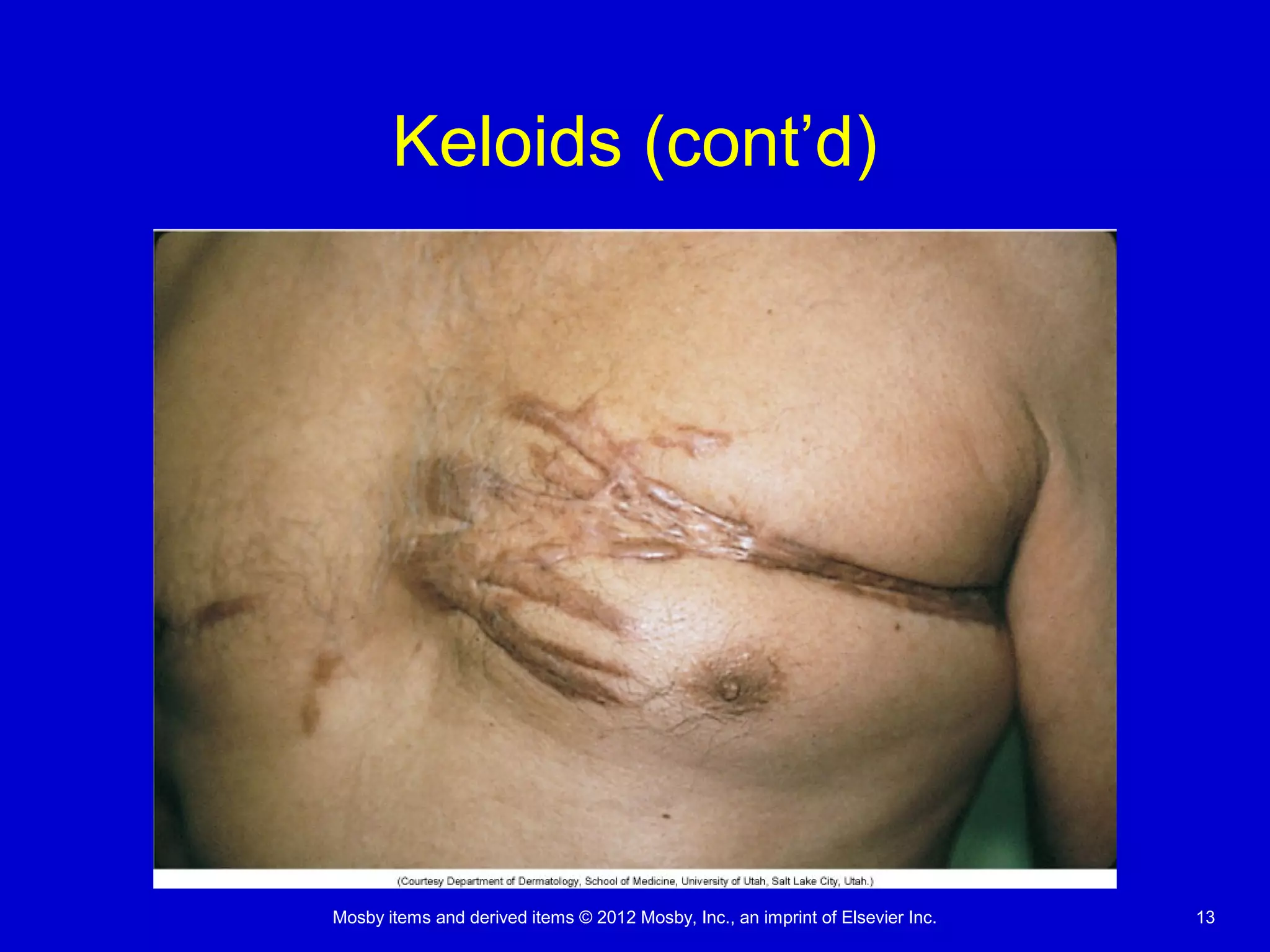Mosby items and derived items © 2012 Mosby, Inc., an imprint of Elsevier Inc. 13
Keloids (cont’d)
 