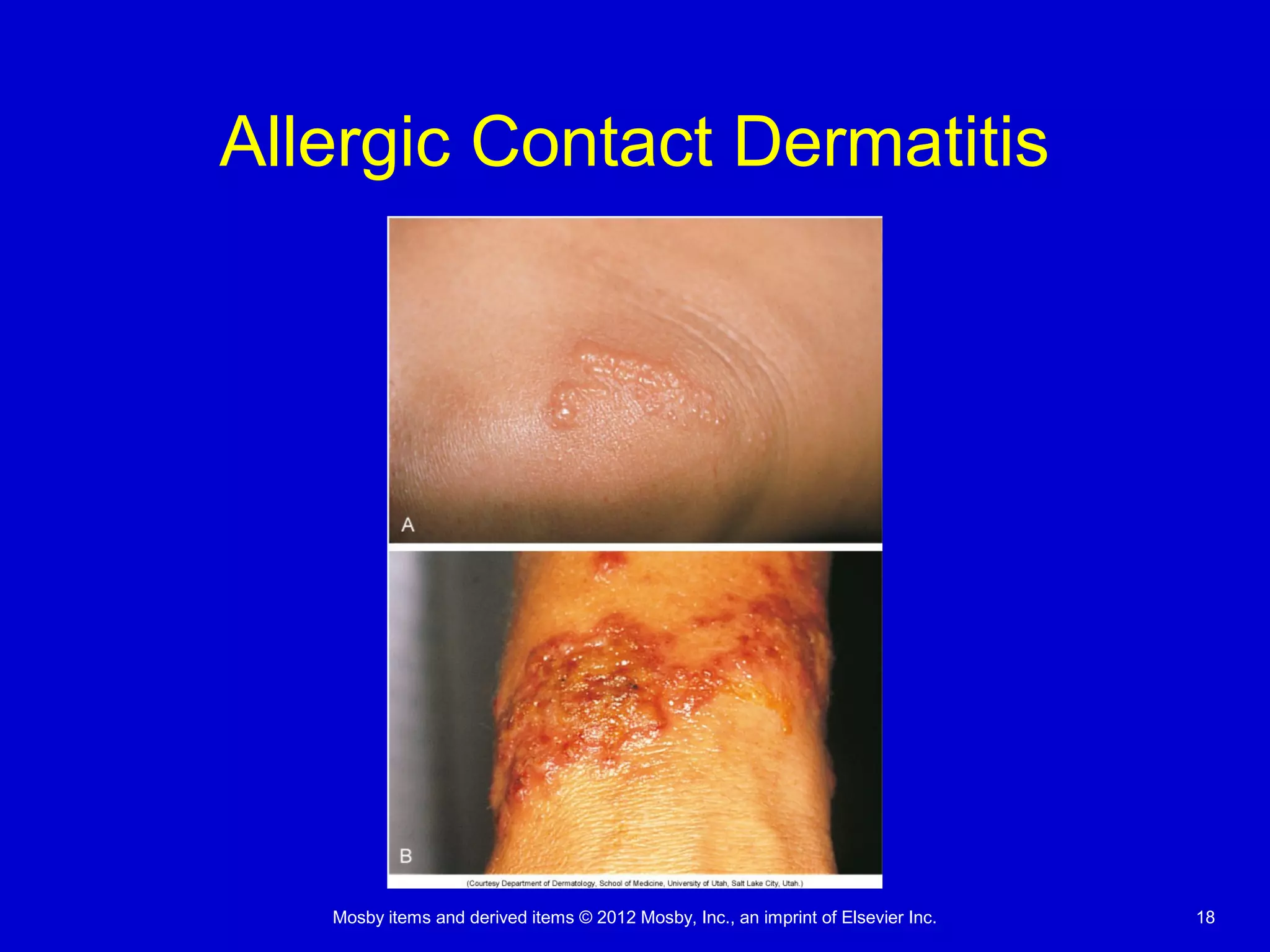 Mosby items and derived items © 2012 Mosby, Inc., an imprint of Elsevier Inc. 18
Allergic Contact Dermatitis
 
