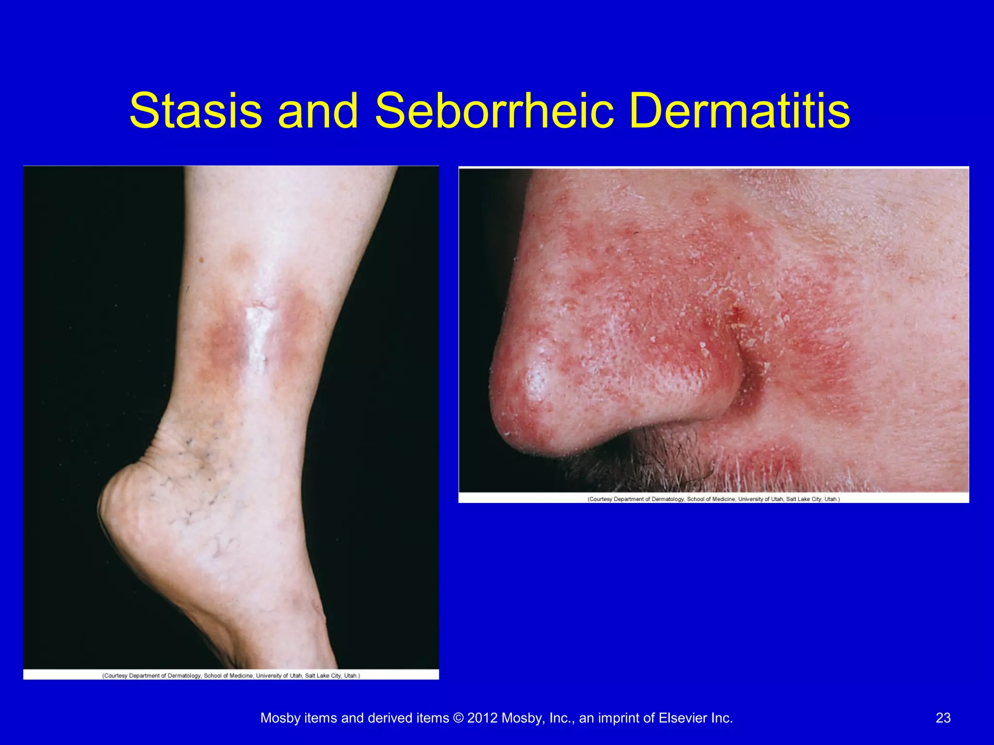 Mosby items and derived items © 2012 Mosby, Inc., an imprint of Elsevier Inc. 23
Stasis and Seborrheic Dermatitis
 