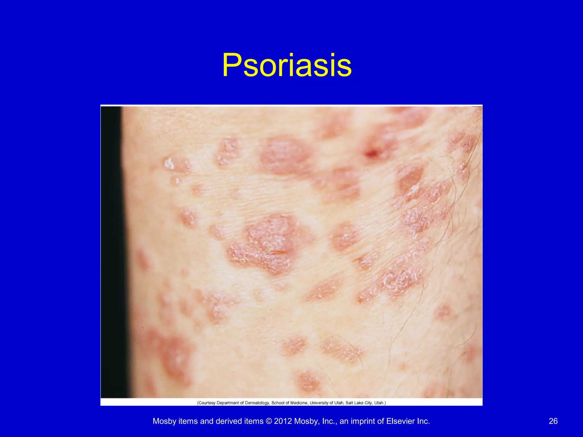 Mosby items and derived items © 2012 Mosby, Inc., an imprint of Elsevier Inc. 26
Psoriasis
 