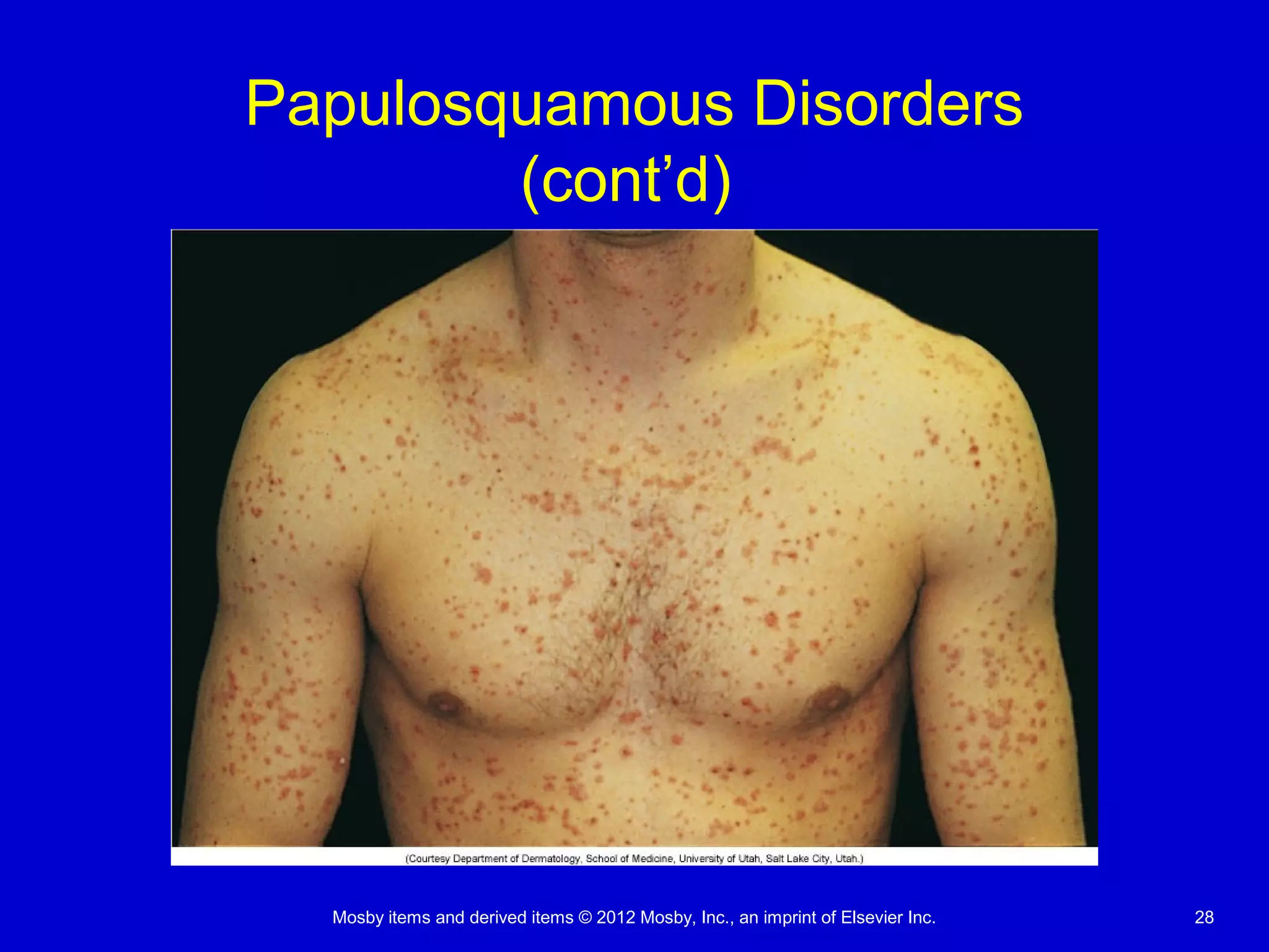 Mosby items and derived items © 2012 Mosby, Inc., an imprint of Elsevier Inc. 28
Papulosquamous Disorders
(cont’d)
 