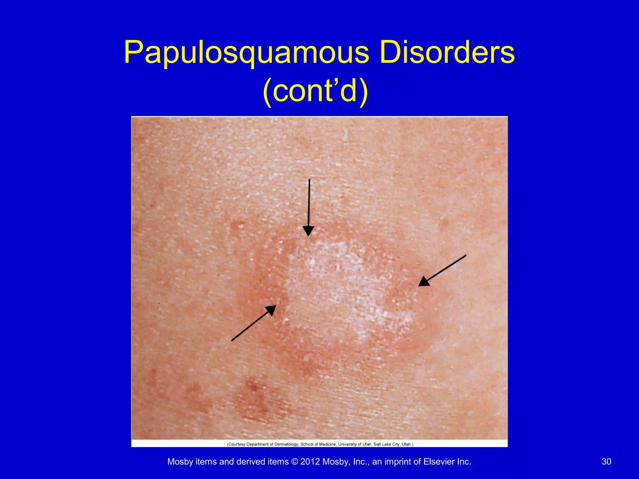 Mosby items and derived items © 2012 Mosby, Inc., an imprint of Elsevier Inc. 30
Papulosquamous Disorders
(cont’d)
 