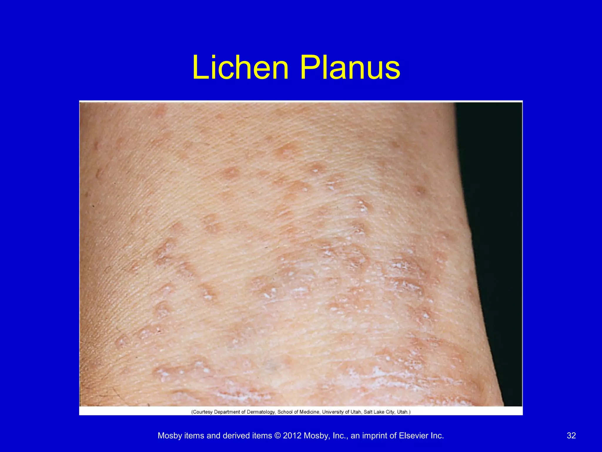 Mosby items and derived items © 2012 Mosby, Inc., an imprint of Elsevier Inc. 32
Lichen Planus
 