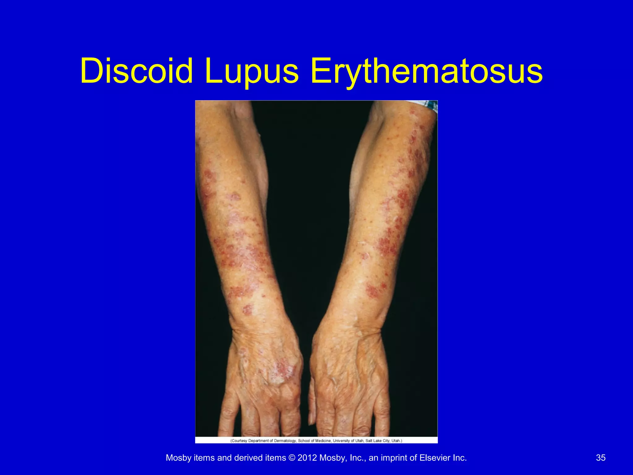 Mosby items and derived items © 2012 Mosby, Inc., an imprint of Elsevier Inc. 35
Discoid Lupus Erythematosus
 
