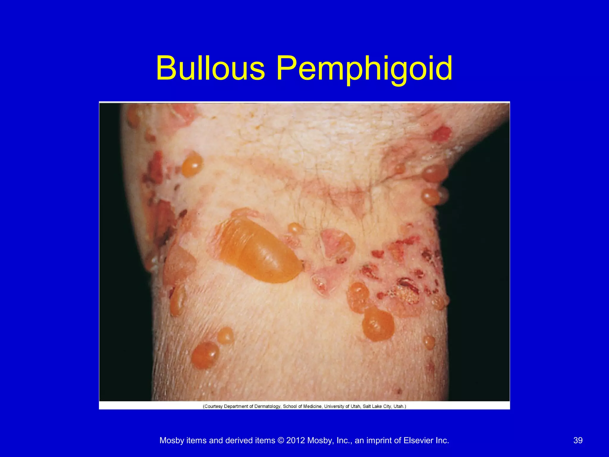 Mosby items and derived items © 2012 Mosby, Inc., an imprint of Elsevier Inc. 39
Bullous Pemphigoid
 