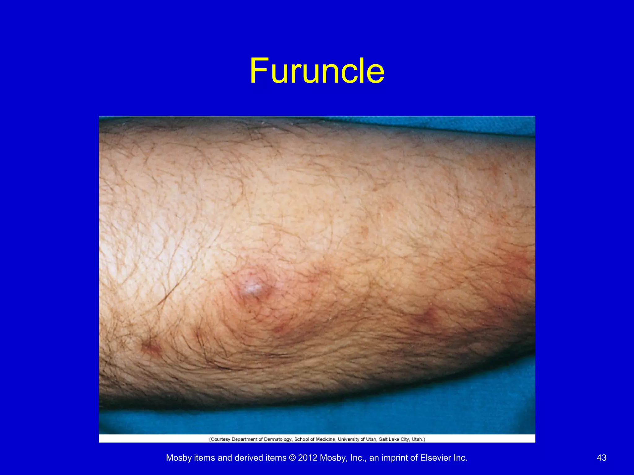 Mosby items and derived items © 2012 Mosby, Inc., an imprint of Elsevier Inc. 43
Furuncle
 