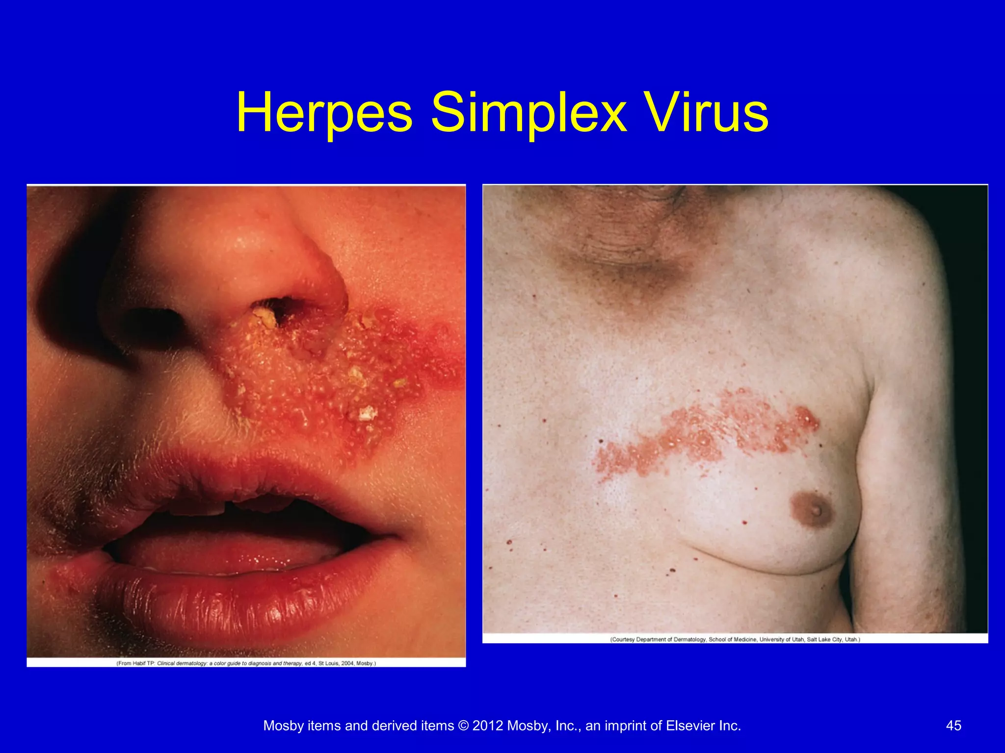 Mosby items and derived items © 2012 Mosby, Inc., an imprint of Elsevier Inc. 45
Herpes Simplex Virus
 