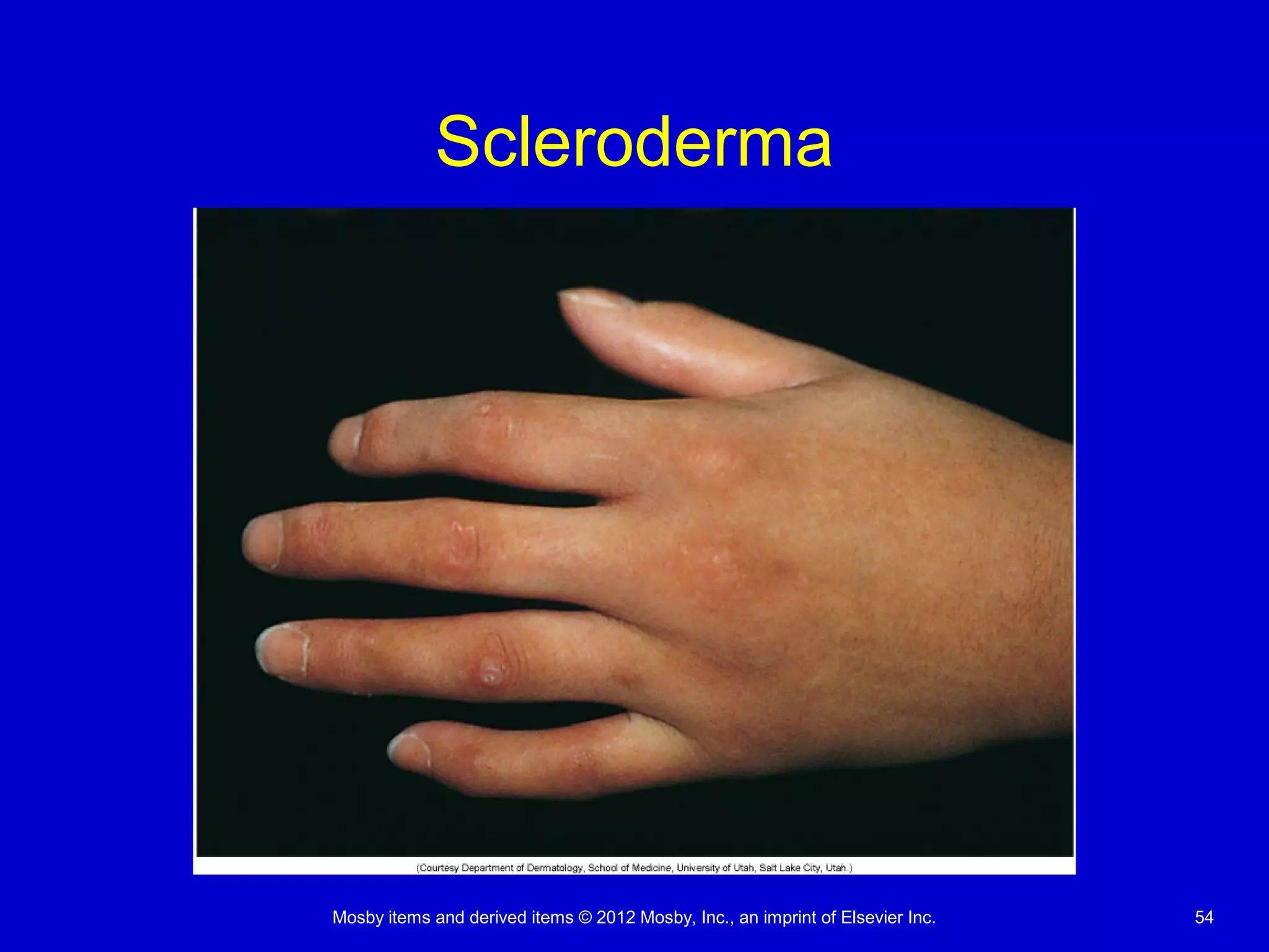 Mosby items and derived items © 2012 Mosby, Inc., an imprint of Elsevier Inc. 54
Scleroderma
 