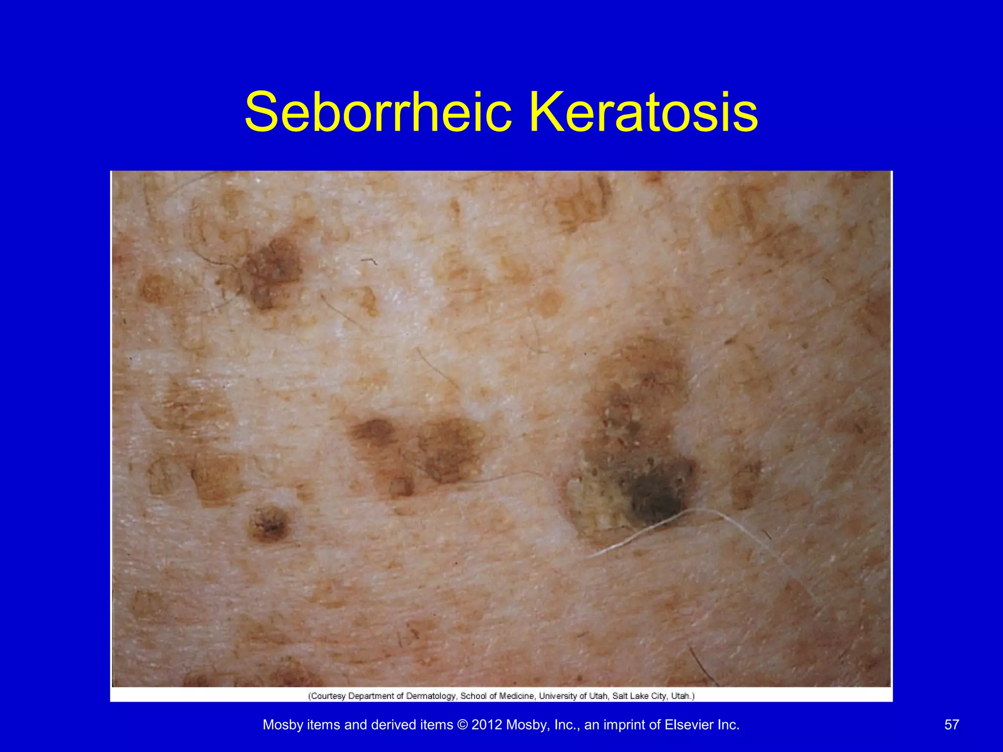 Mosby items and derived items © 2012 Mosby, Inc., an imprint of Elsevier Inc. 57
Seborrheic Keratosis
 