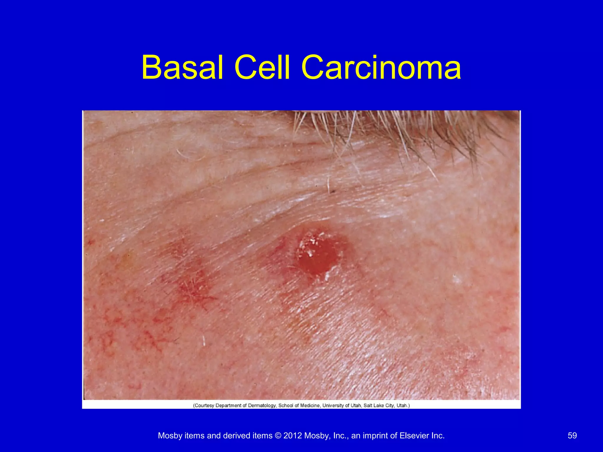Mosby items and derived items © 2012 Mosby, Inc., an imprint of Elsevier Inc. 59
Basal Cell Carcinoma
 
