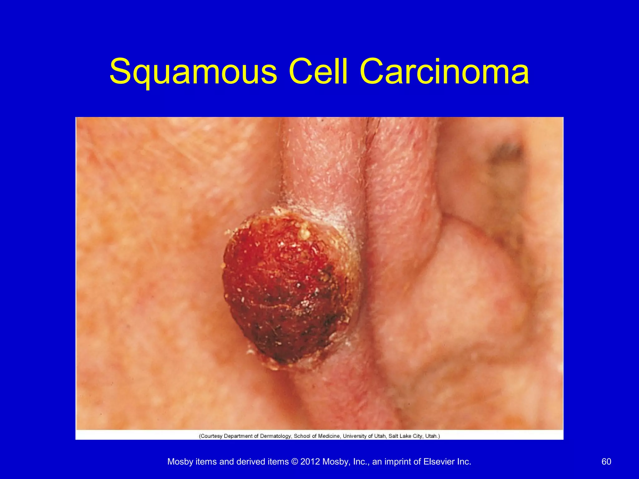 Mosby items and derived items © 2012 Mosby, Inc., an imprint of Elsevier Inc. 60
Squamous Cell Carcinoma
 