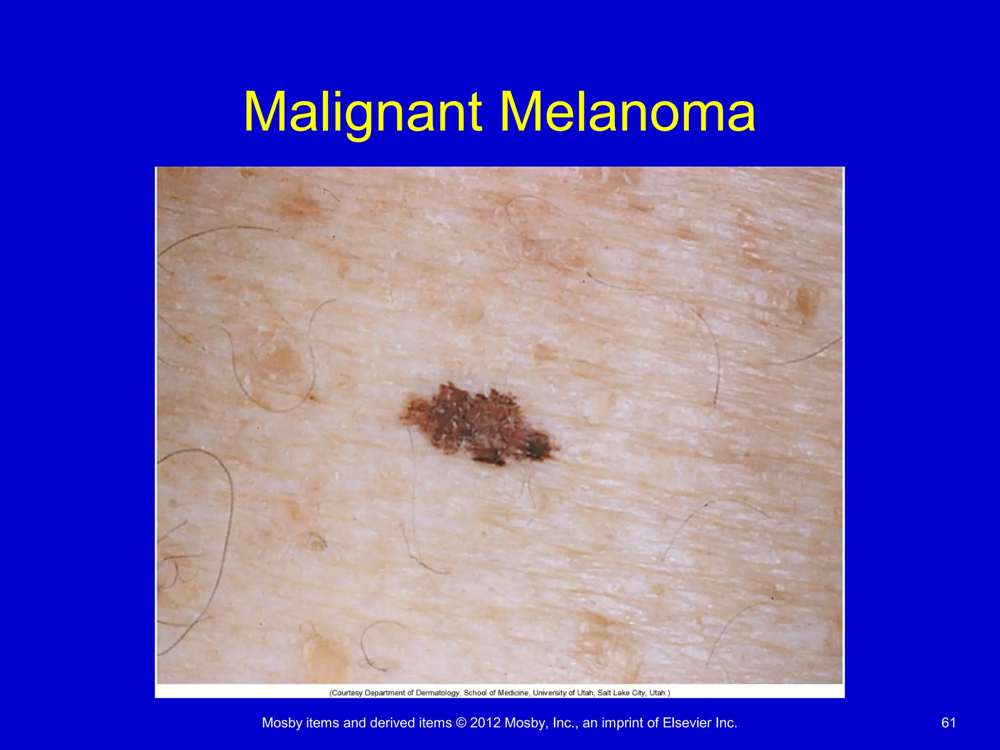 Mosby items and derived items © 2012 Mosby, Inc., an imprint of Elsevier Inc. 61
Malignant Melanoma
 