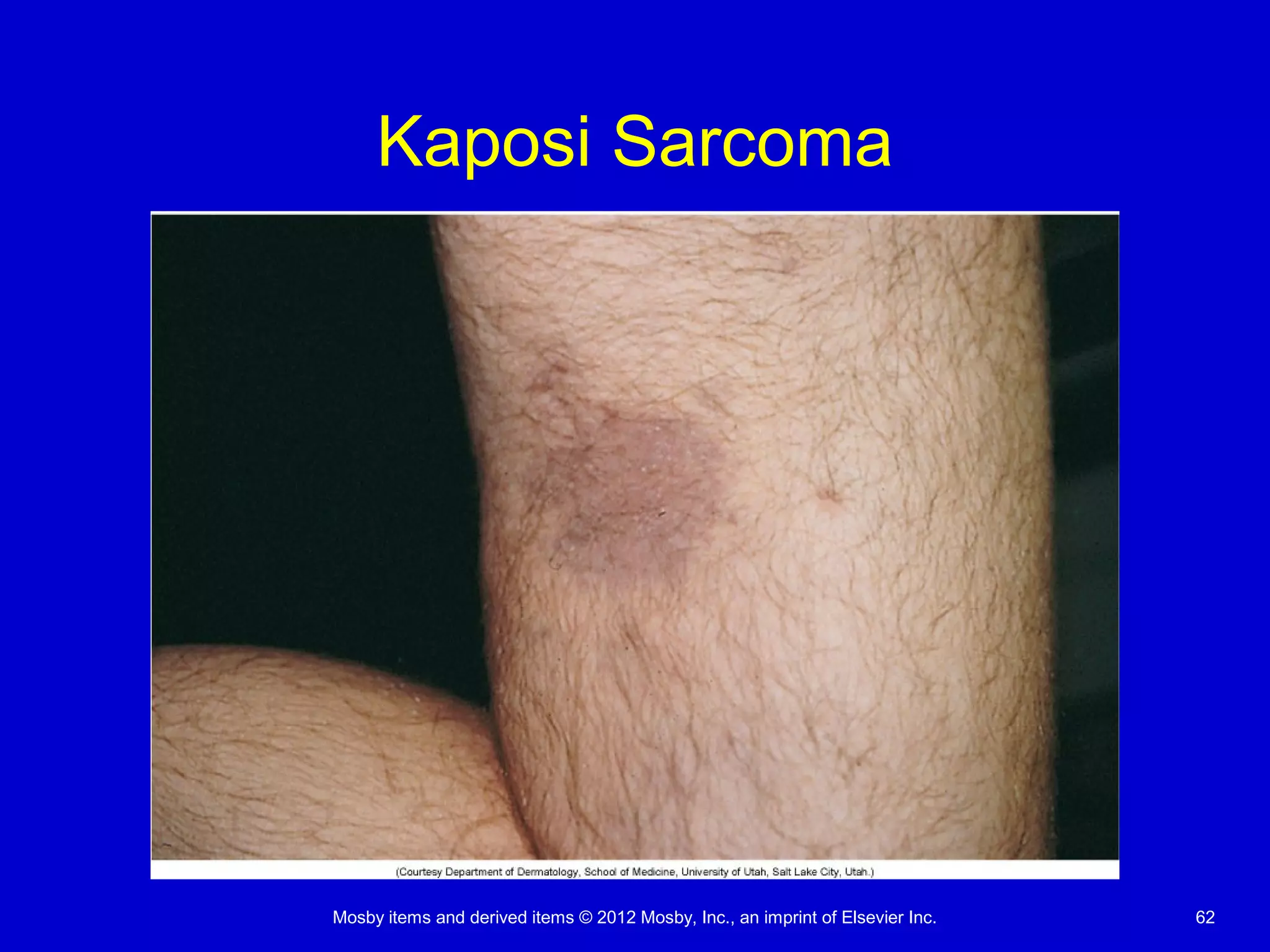 Mosby items and derived items © 2012 Mosby, Inc., an imprint of Elsevier Inc. 62
Kaposi Sarcoma
 