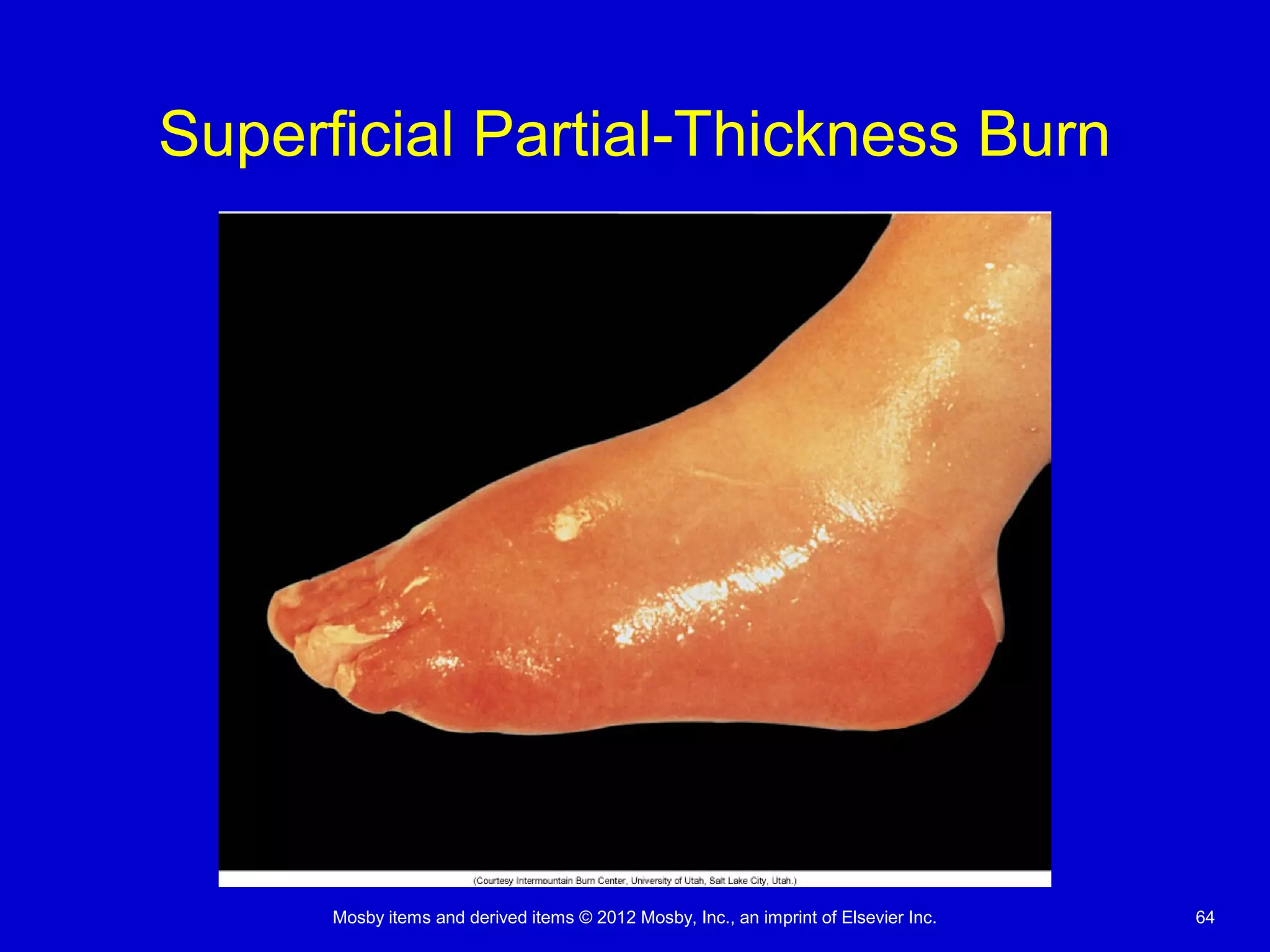 Mosby items and derived items © 2012 Mosby, Inc., an imprint of Elsevier Inc. 64
Superficial Partial-Thickness Burn
 