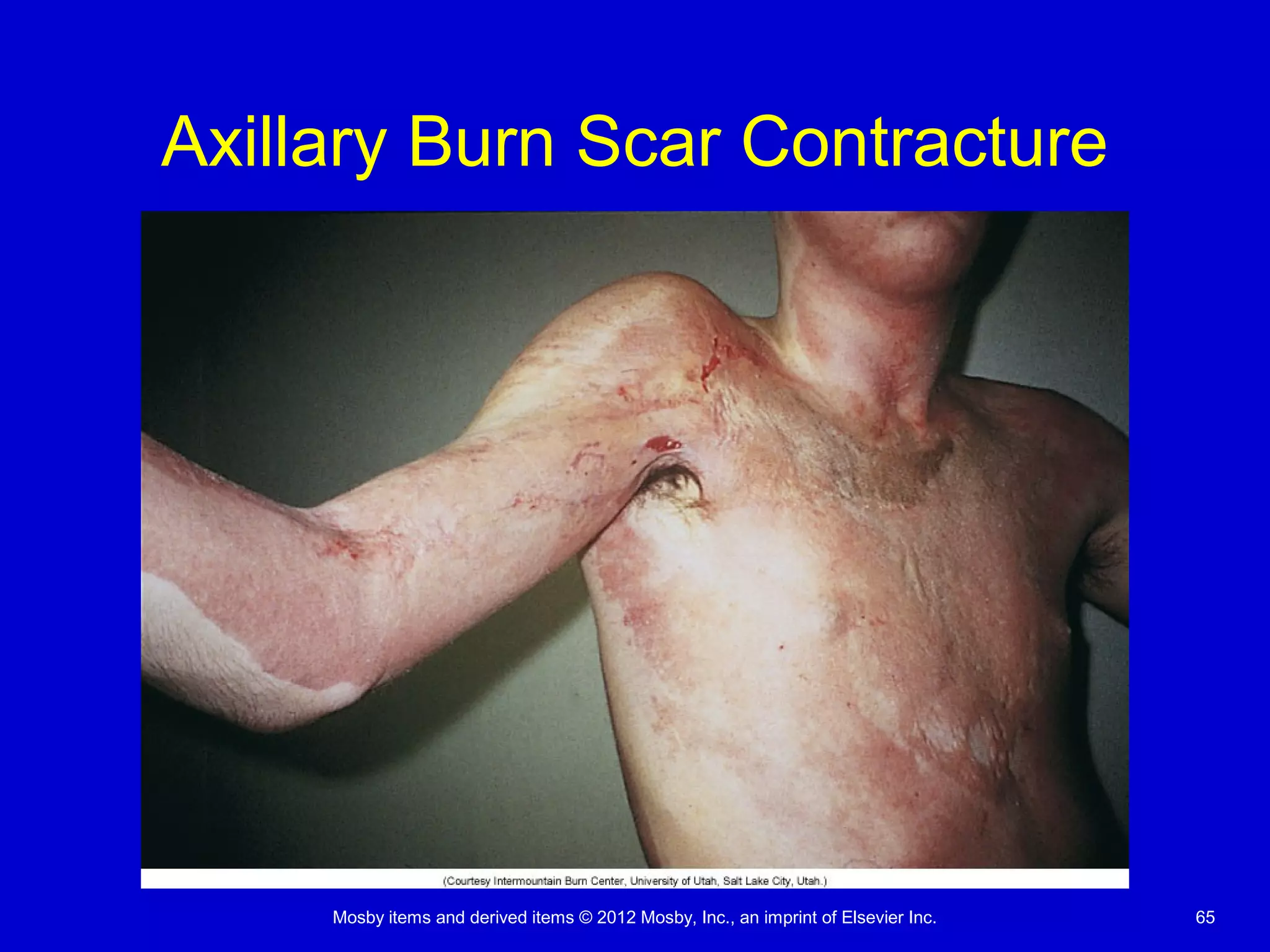 Mosby items and derived items © 2012 Mosby, Inc., an imprint of Elsevier Inc. 65
Axillary Burn Scar Contracture
 